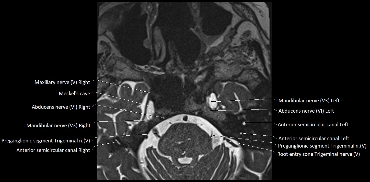 Cranial nerve anatomy axial MRI 3T image 44.webp